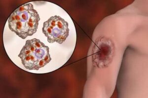 Sedes en alerta ante un caso positivo de Leishmaniasis en la Chiquitania