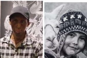 Pedro, el artista que sufrió quemaduras a causa de una explosión, no quiere fama solo calidad de vida